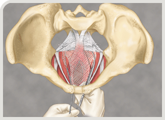 Elevate� Apical & Posterior Prolapse Repair System. Total transvaginal approach with no external incisions, eliminating the potential for associated buttock pain.