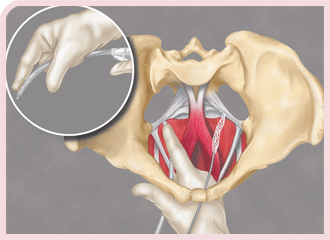 Elevate� Apical & Posterior Prolapse Repair System. Total transvaginal approach with no external incisions, eliminating the potential for associated buttock pain.