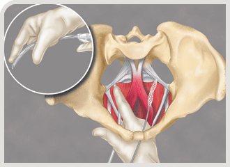 Elevate� Apical & Posterior Prolapse Repair System. Total transvaginal approach with no external incisions, eliminating the potential for associated buttock pain.
