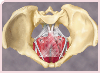 Elevate� Apical & Posterior Prolapse Repair System. Total transvaginal approach with no external incisions, eliminating the potential for associated buttock pain.